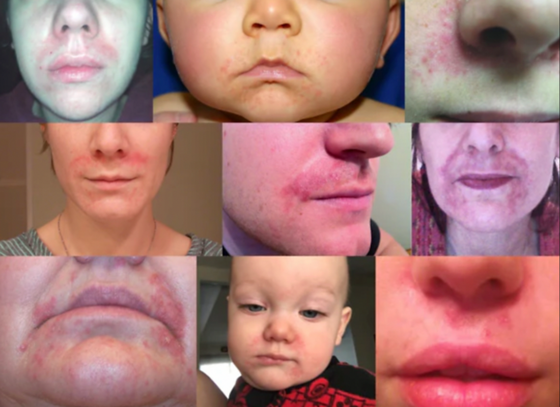 Understanding Perioral Dermatitis: Causes, Symptoms, and Treatment