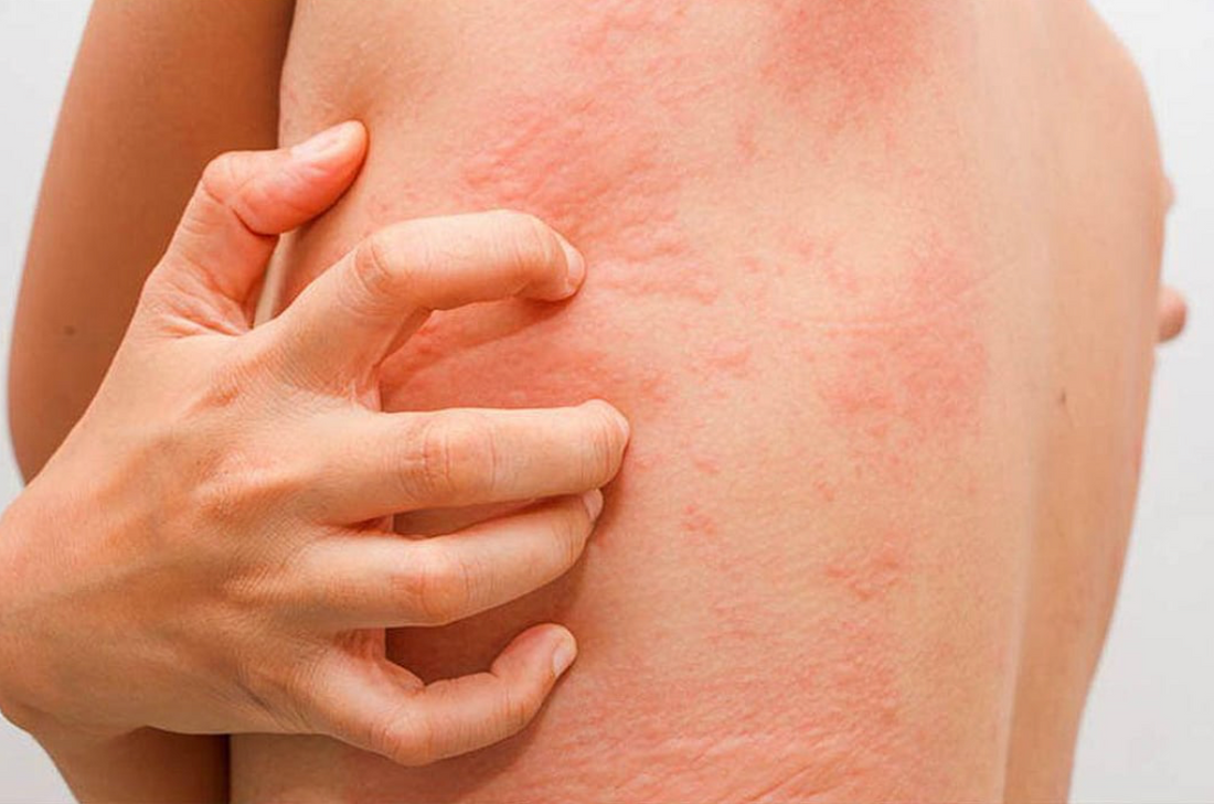 How to Treat Inflammatory Skin Conditions: Inside & Out